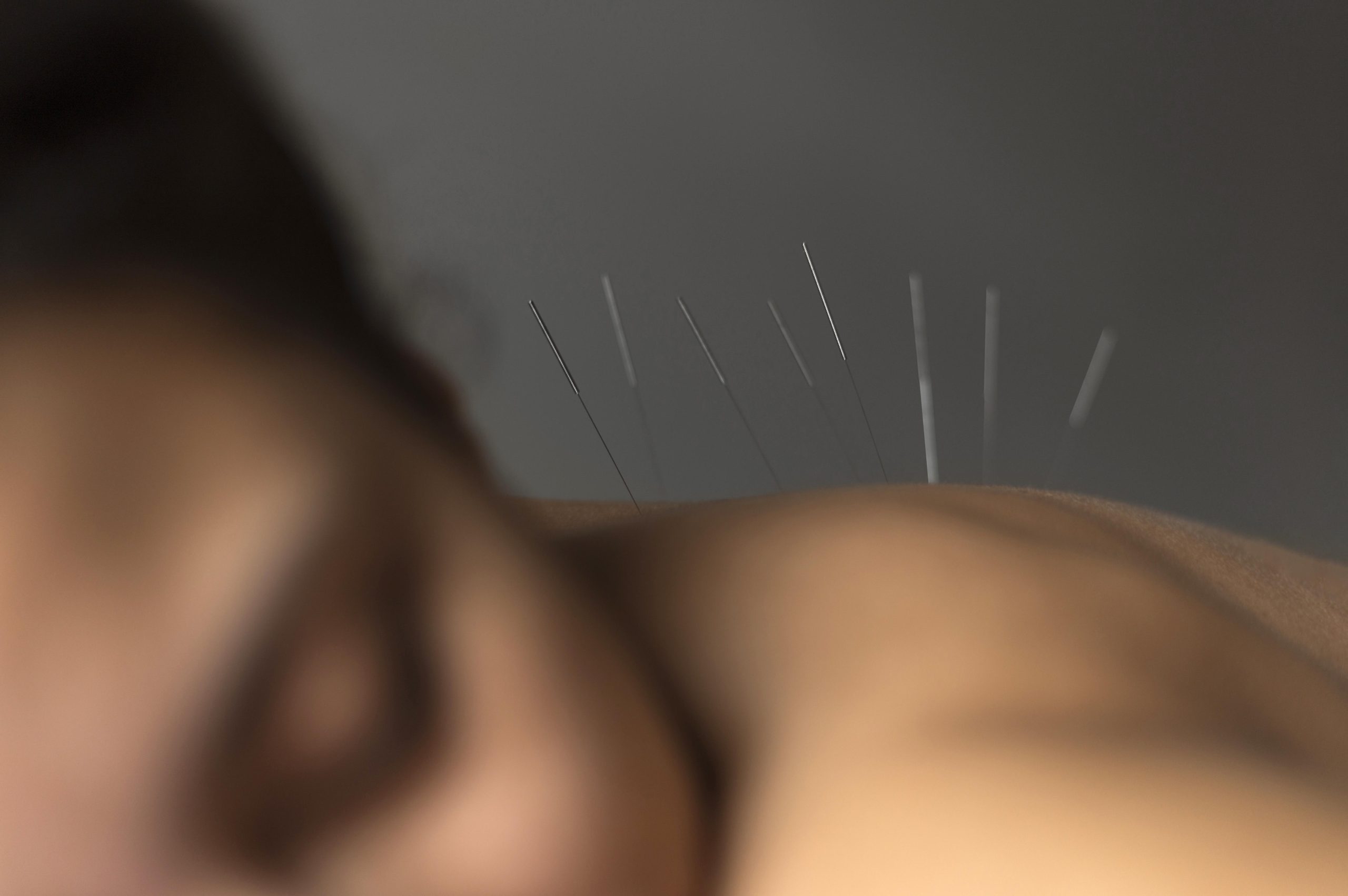 close up patient during acupuncture procedure scaled